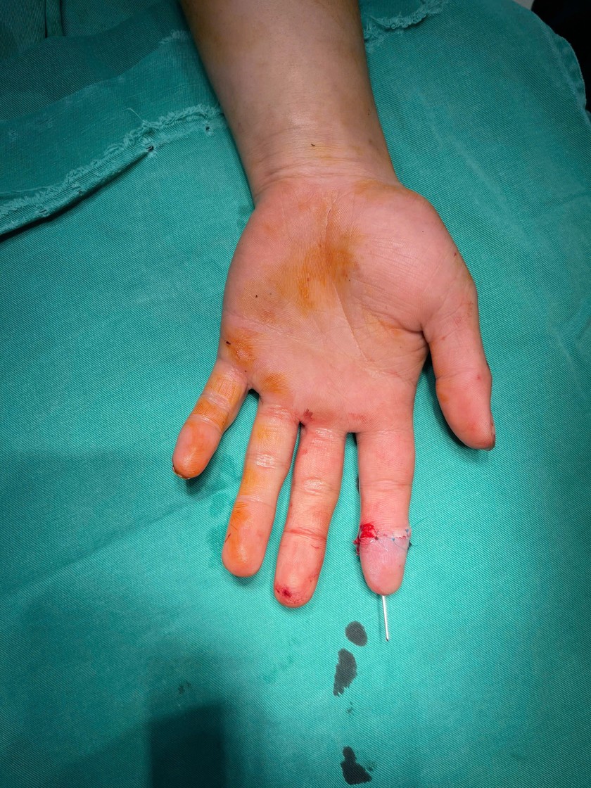 Sau 14 ng&agrave;y, ng&oacute;n trỏ của bệnh nh&acirc;n bắt đầu hồi phục t&iacute;ch cực. Ảnh: Thanh Thanh