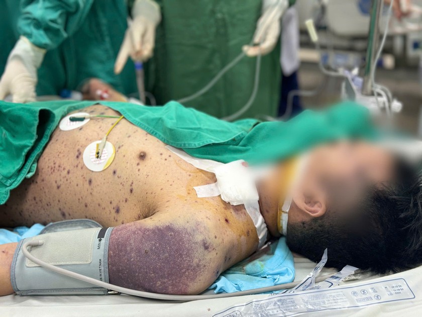 Bệnh nh&acirc;n mắc thuỷ đậu đang được điều trị tại Bệnh viện Bệnh Nhiệt đới Trung ương. Ảnh: Thanh Thanh.