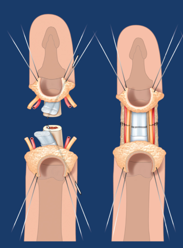 C&aacute;c mạch m&aacute;u v&agrave; d&acirc;y thần kinh được hồi phục sau vi phẫu thuật nối ng&oacute;n tay
