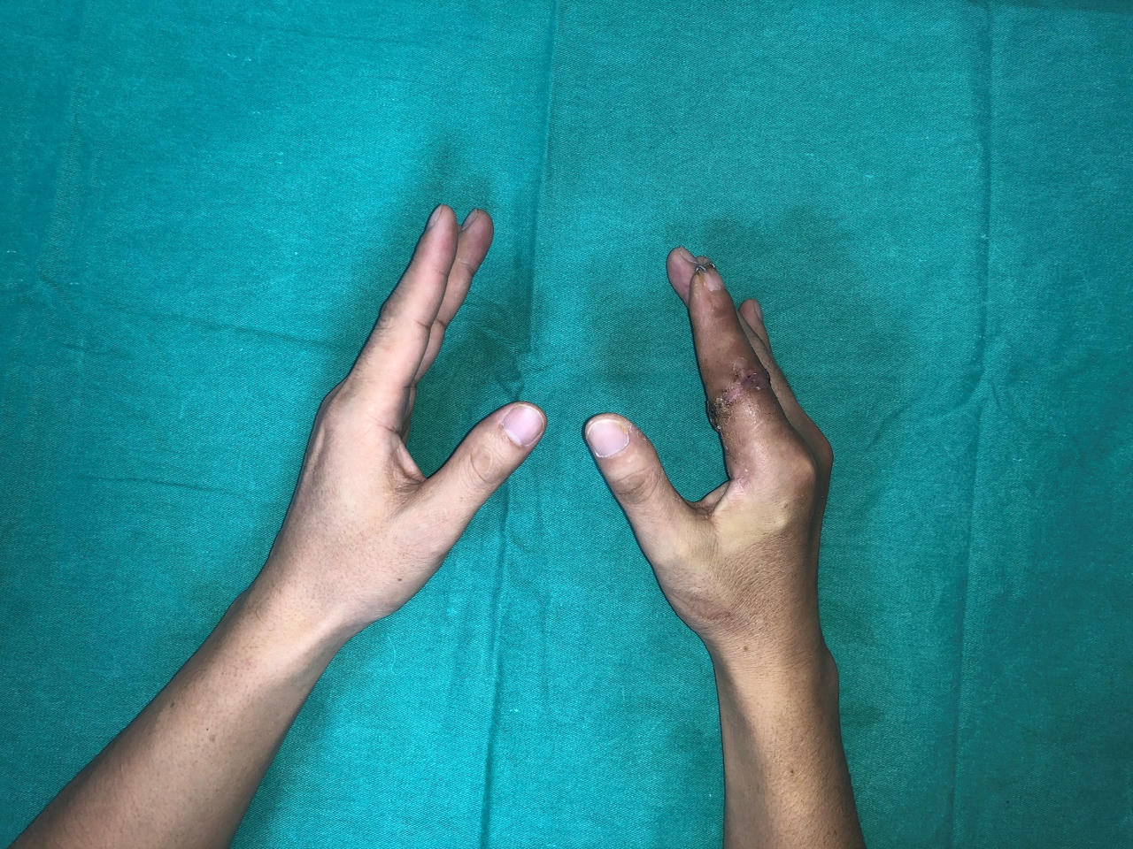 Kỳ t&iacute;ch y khoa: Ng&oacute;n tay thủy thủ bị đứt rời 25 giờ được 'hồi sinh' tại bệnh viện Việt Đức