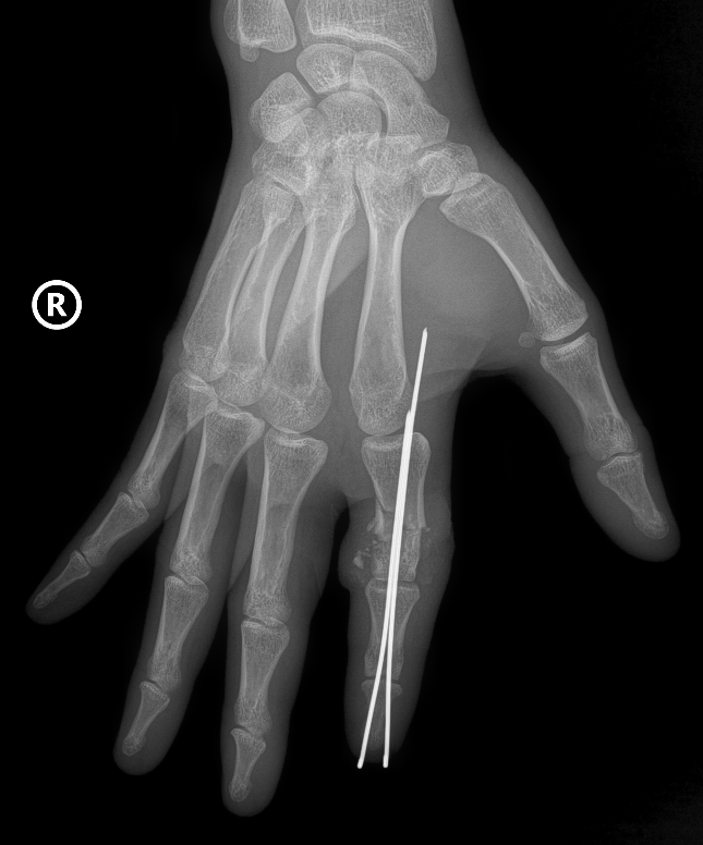 H&igrave;nh ảnh X-Quang phần ng&oacute;n trỏ tay phải bị đứt rời của anh D được định vị v&agrave; cố định bằng kim chuy&ecirc;n dụng