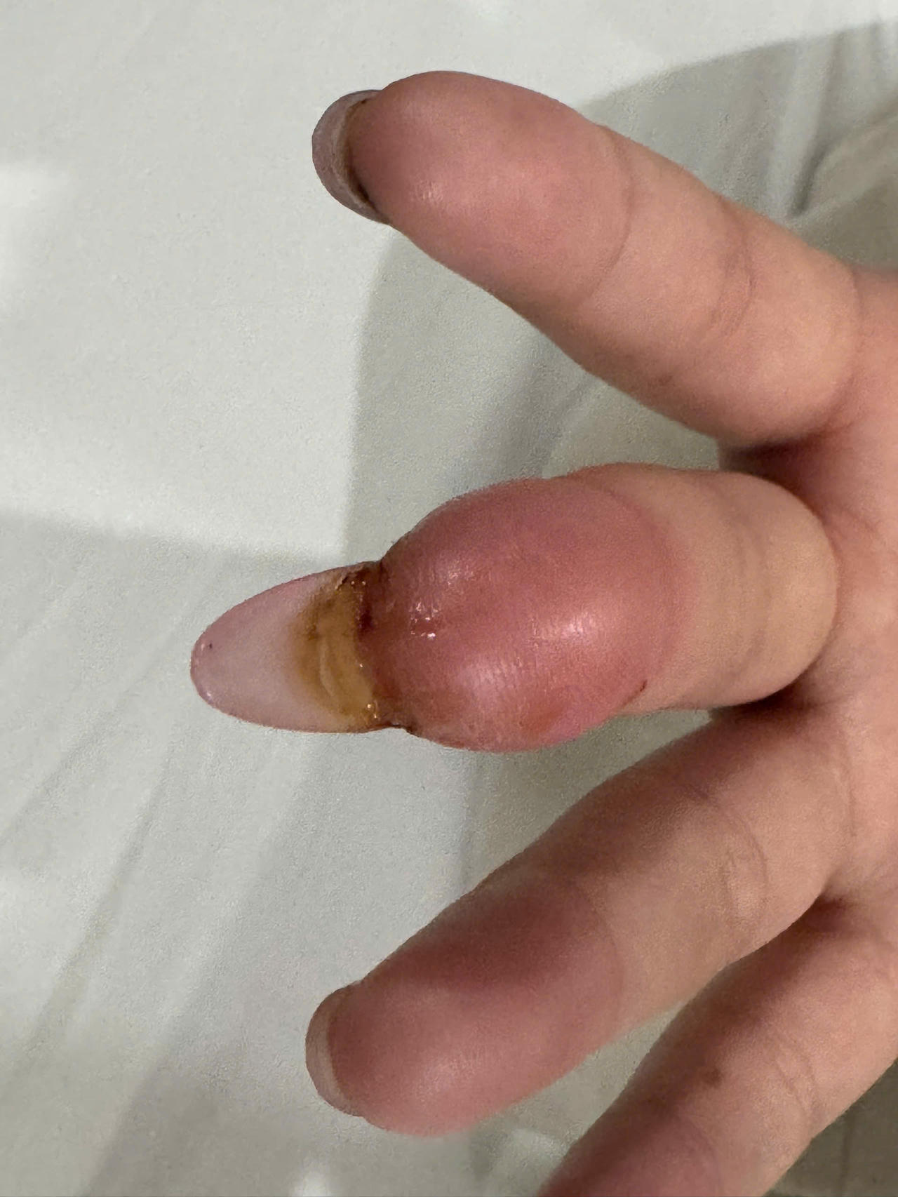 M&oacute;ng tay ch&aacute;u N.H.A bị bẻ lật m&oacute;ng g&acirc;y đau nhức v&agrave; li&ecirc;n tục chảy mủ. Ảnh: Ngọc Ph&uacute;c