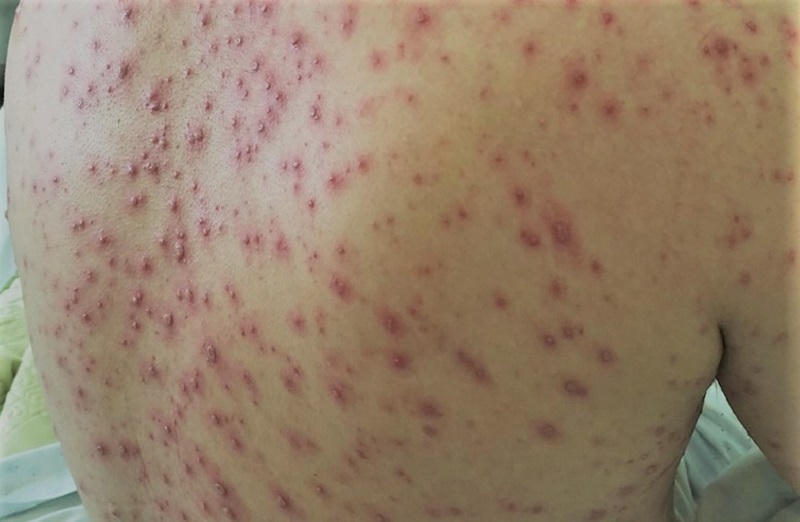 Trường hợp bệnh nh&acirc;n bị thủy đậu biến chứng - Ảnh minh họa (nguồn: Internet).