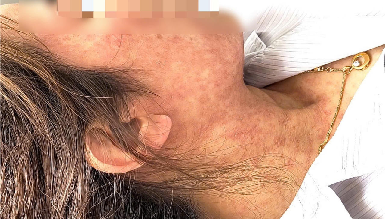 X&eacute;t nghiệm cho thấy chỉ số vi&ecirc;m CRP tăng cao (43,8 mg/L) v&agrave; dương t&iacute;nh với virus sởi. Ảnh: Thanh Thanh