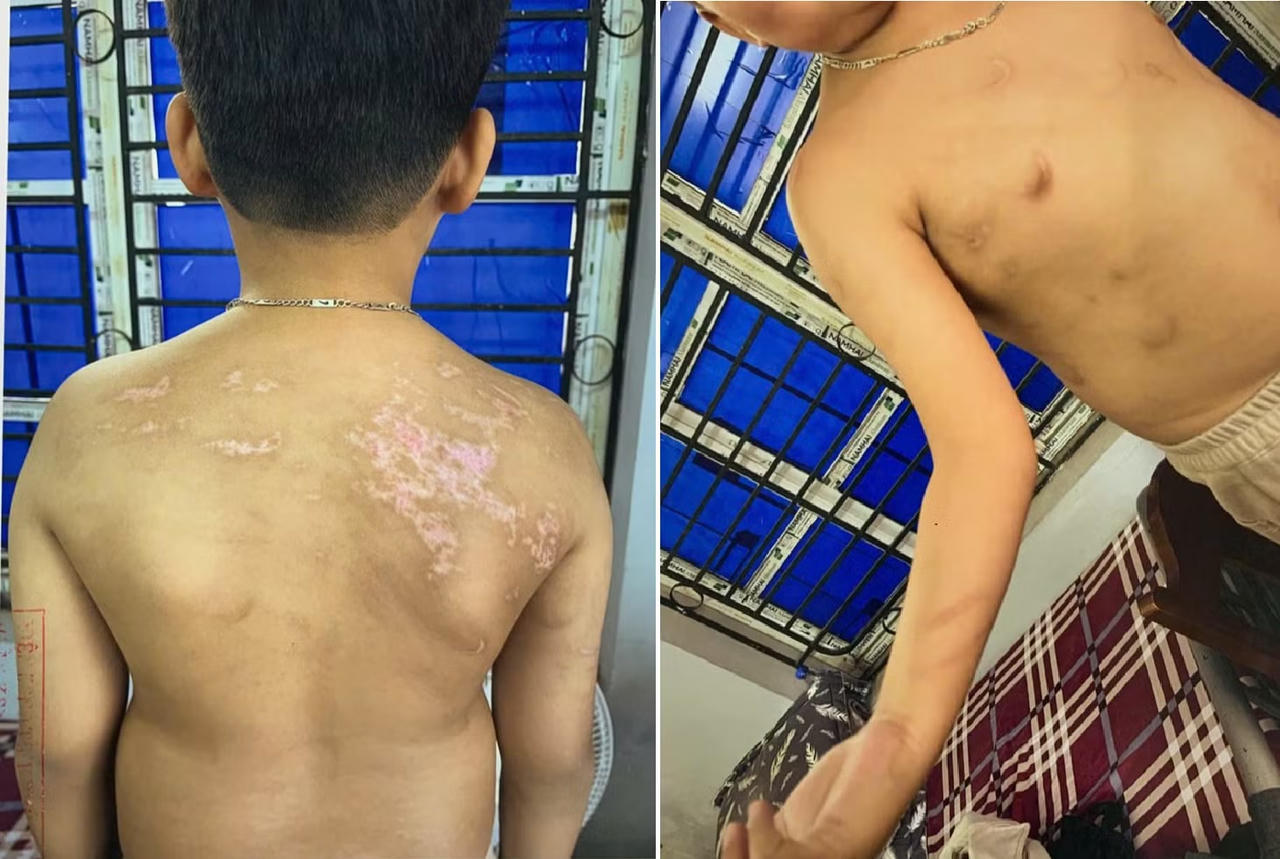 Kết quả gi&aacute;m định của Trung t&acirc;m Ph&aacute;p y tỉnh Ph&uacute; Thọ x&aacute;c định ch&aacute;u b&eacute; c&oacute; 21 vết sẹo v&agrave; 20 vết rối loạn sắc tố da m&agrave;u n&acirc;u tr&ecirc;n cơ thể. (Nguồn ảnh: C&ocirc;ng an tỉnh Ph&uacute; Thọ)&nbsp;