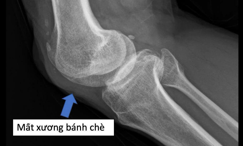 H&igrave;nh ảnh X-Quang đầu gối người bệnh kh&ocirc;ng c&ograve;n xương b&aacute;nh ch&egrave;.