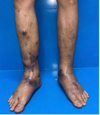 Nam thanh niên mắc bệnh cực hiếm