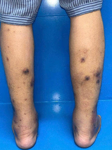 Nam thanh niên mắc bệnh cực hiếm