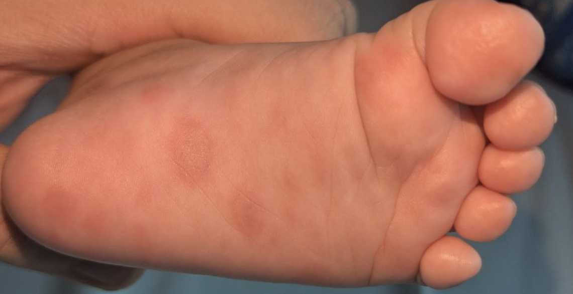 Bé gái 2 tháng tuổi bị giang mai bẩm sinh, bác sĩ cảnh báo các 'mẹ bầu'
