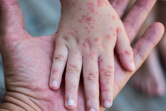 Cả nước ghi nhận gần 39.000 ca nghi sởi, 5 ca tử vong