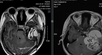 Thiếu nữ 14 tuổi mắc u não hiếm gặp do hội chứng di truyền Von Hippel-Lindau