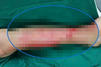 Liên tiếp nhiều người gặp biến chứng nguy hiểm do đắp 'thuốc lá' chữa bỏng