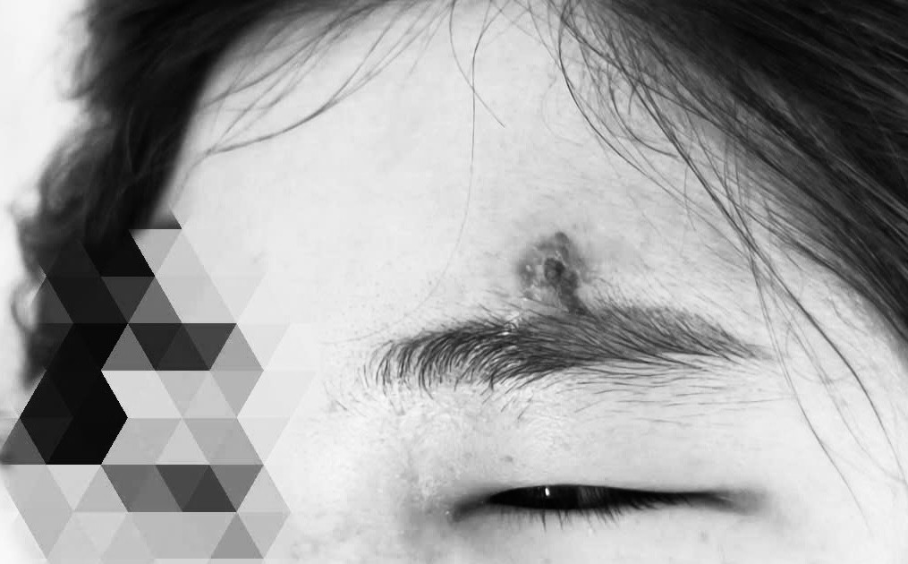 Người phụ nữ nhập viện cấp cứu vì thói quen nặn mụn bằng tay