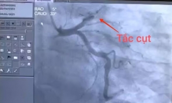 Hút 2 bao thuốc lá mỗi ngày, người đàn ông 43 tuổi suýt mất mạng